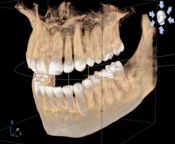 What are the benefits of a 3D CAT scan?