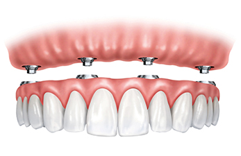 Rather than living with the discomfort and hassles of dentures, many people are opting for what is called All-On-Four dental implant restoration.