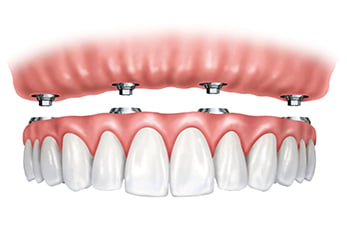 Rather than living with the discomfort and hassles of dentures, many people are opting for what is called All-On-Four dental implant restoration.